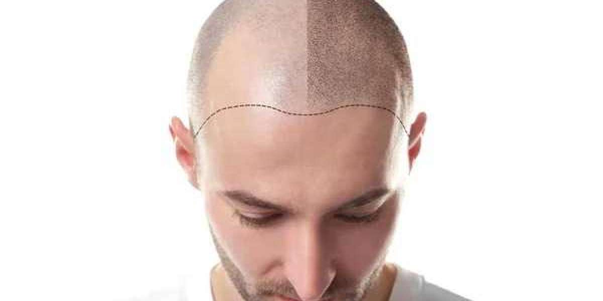 Hair Transplant in Islamabad for Patchy Hair Loss at Glamorous Aesthetic Clinic