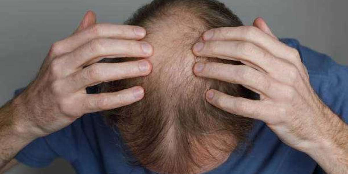Can Finasteride Slow Male Pattern Baldness?