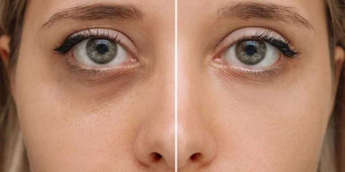 Who Qualifies for Eyelid Surgery in Riyadh? Assessing Ideal Candidates and Expectations