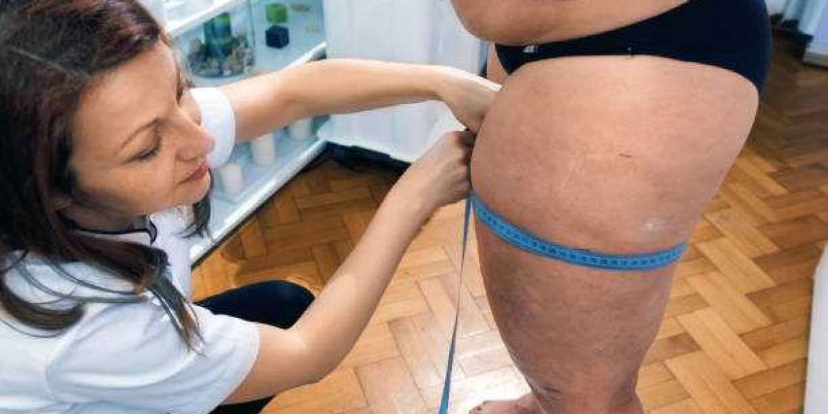 What Lymphedema Therapists Specialize in Lipedema?