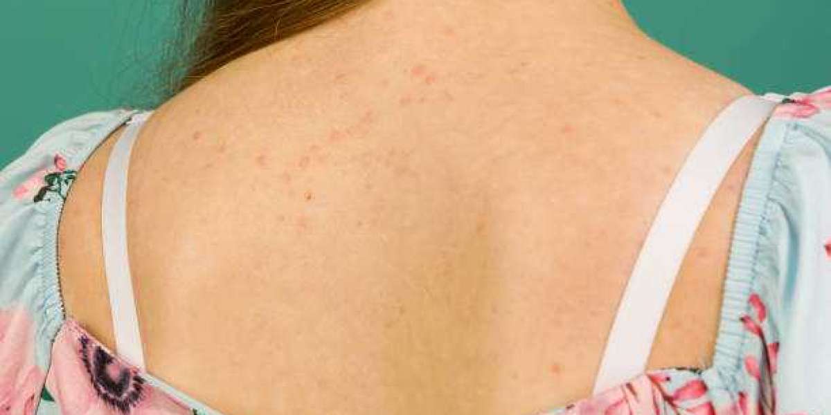 How to Treat Back Acne and Its Effects? Turmeric Paste for Anti-Inflammatory Aid