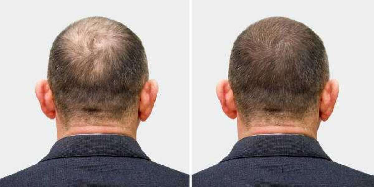 Hats After Hair Transplant: When and How to Wear Them Properly