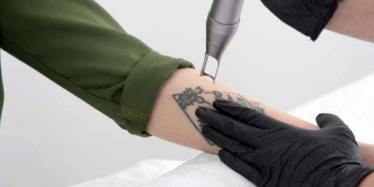 Can Laser Tattoo Removal Completely Erase Ink?
