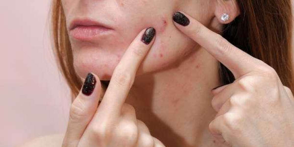 Can Diet Changes Improve Acne Treatment Results?
