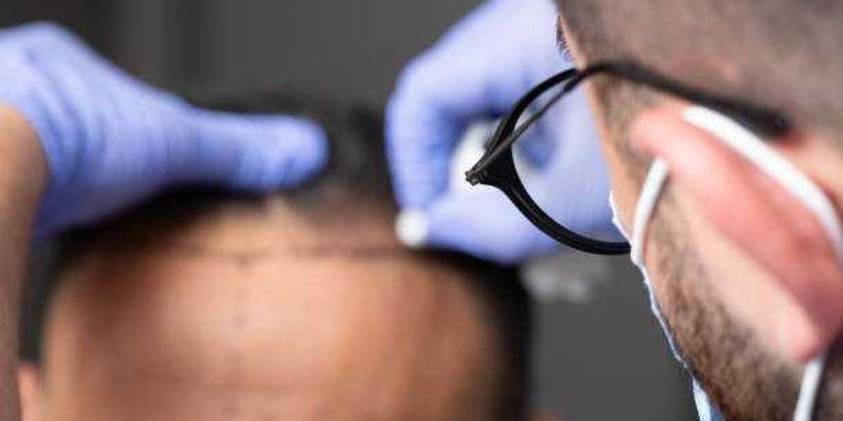 The Role of Patient Education in Successful Hair Restoration