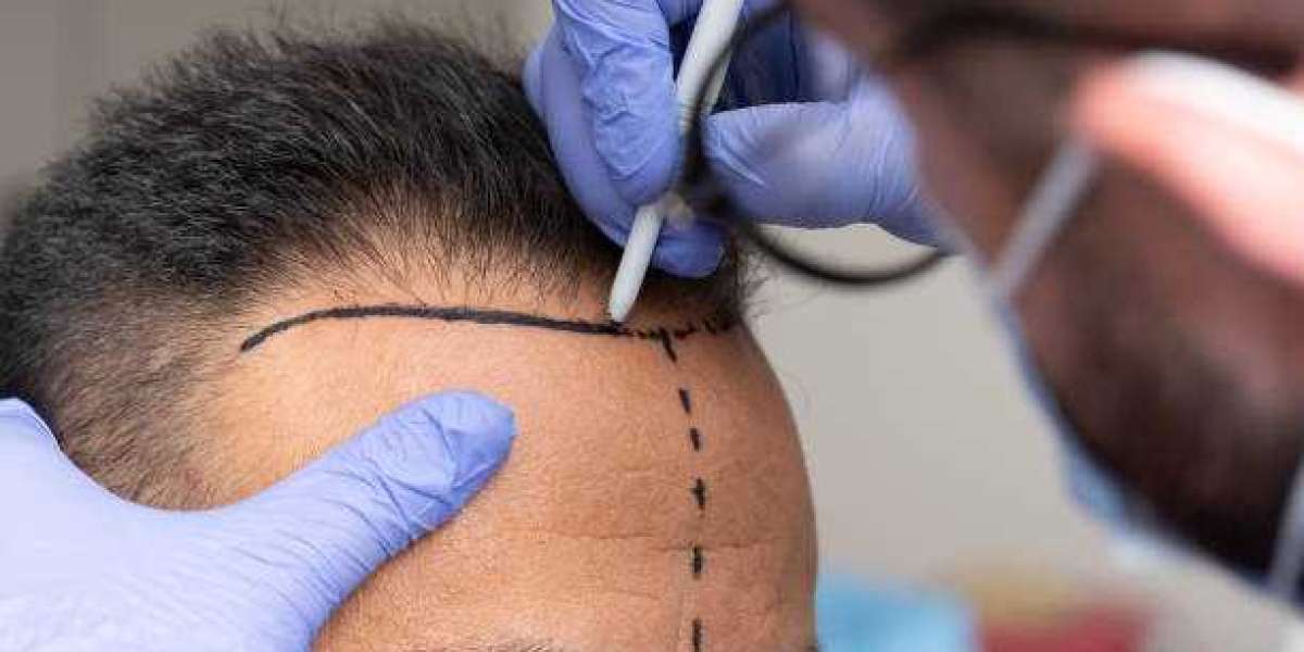 Achieve Natural-Looking Results with DHI Hair Transplant in Riyadh