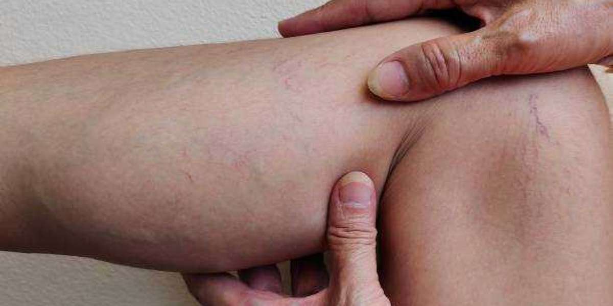 Educating Riyadh on Lipedema: Symptoms, Diagnosis, and Care Tips