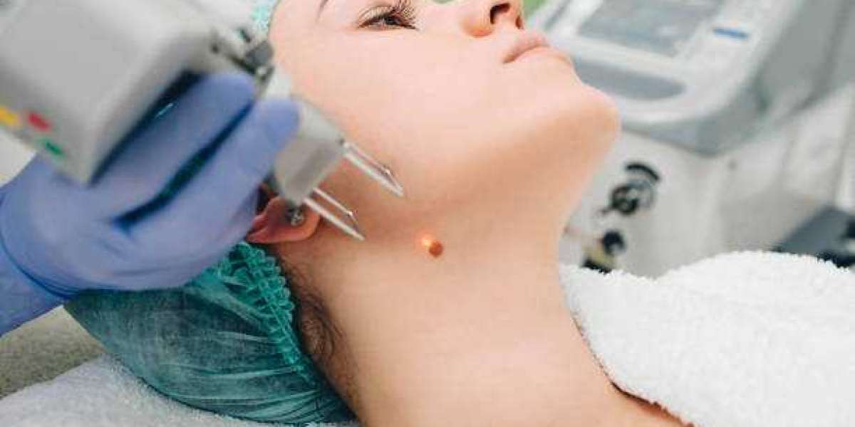 How Do Salicylic Acid Treatments Remove Warts?