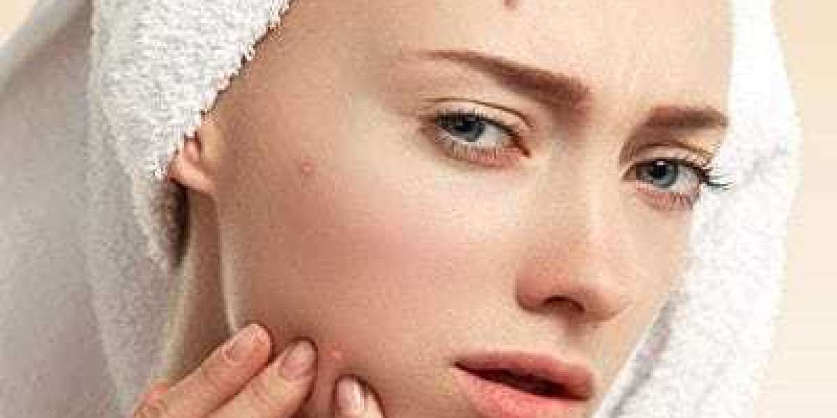 Types of Pimple Treatments Available in Islamabad