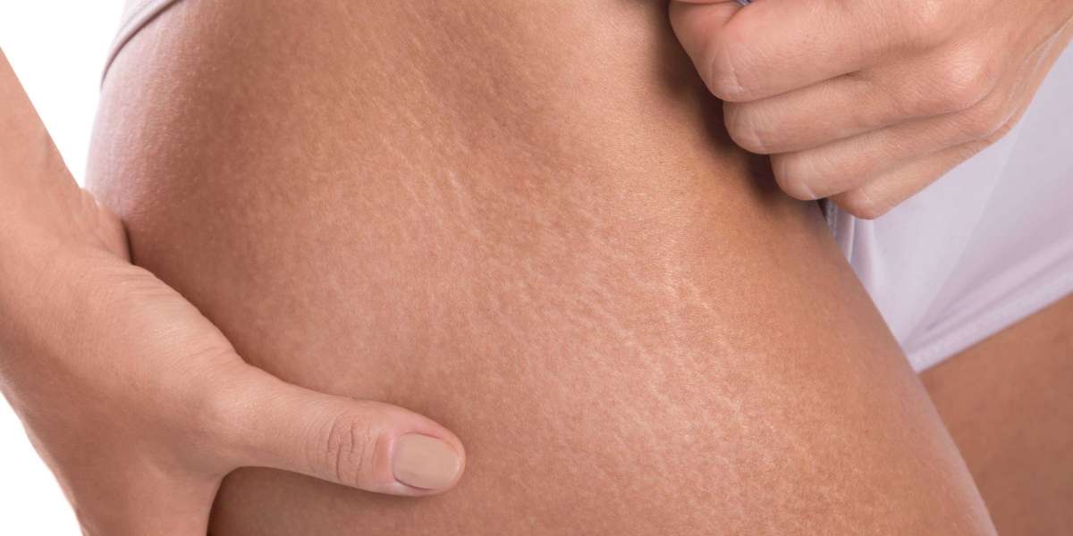 How Stretch Mark Removal in Islamabad Improves Skin Texture Naturally