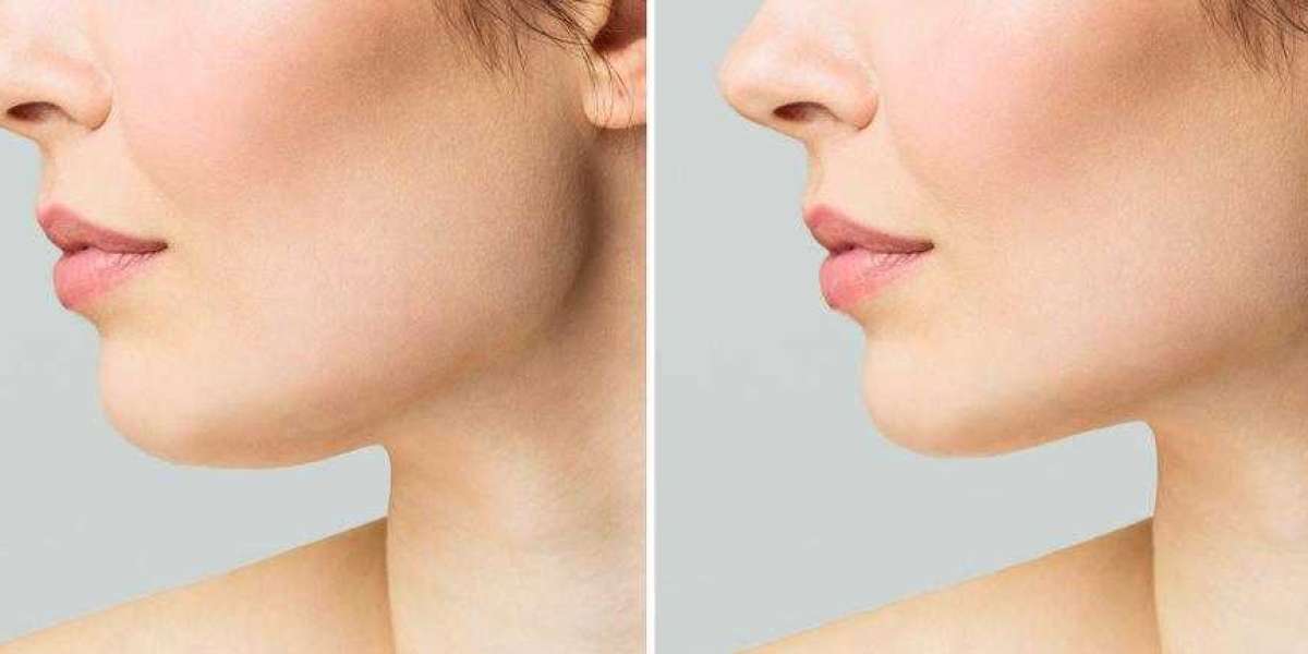 Understanding the Aesthetic Benefits of Chin Reduction in Islamabad