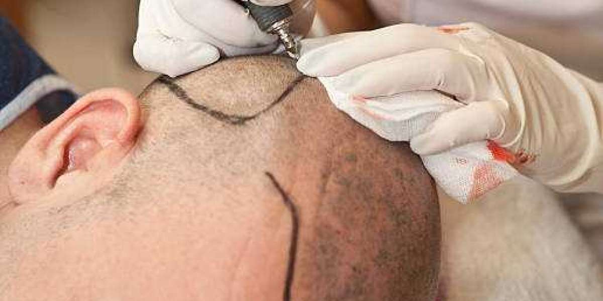 Hair Transplant Benefits for Restoring Hair and Confidence