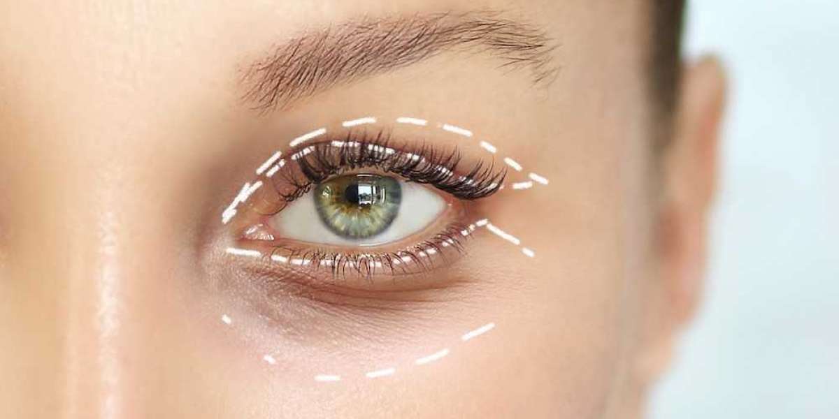 Benefits of Eyelid Surgery in Islamabad for Aging Eyes