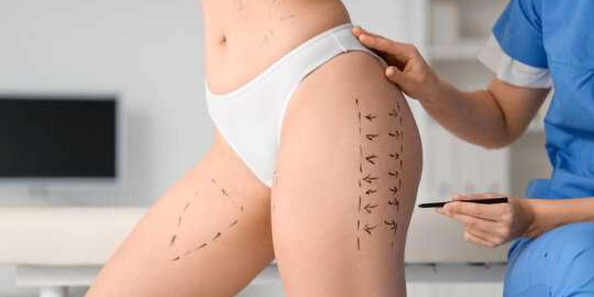 Liposuction in islamabad and Personalized Body Contouring Plans