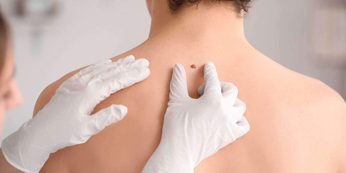 How Mole Removal in Islamabad Improves Skin Appearance Safely