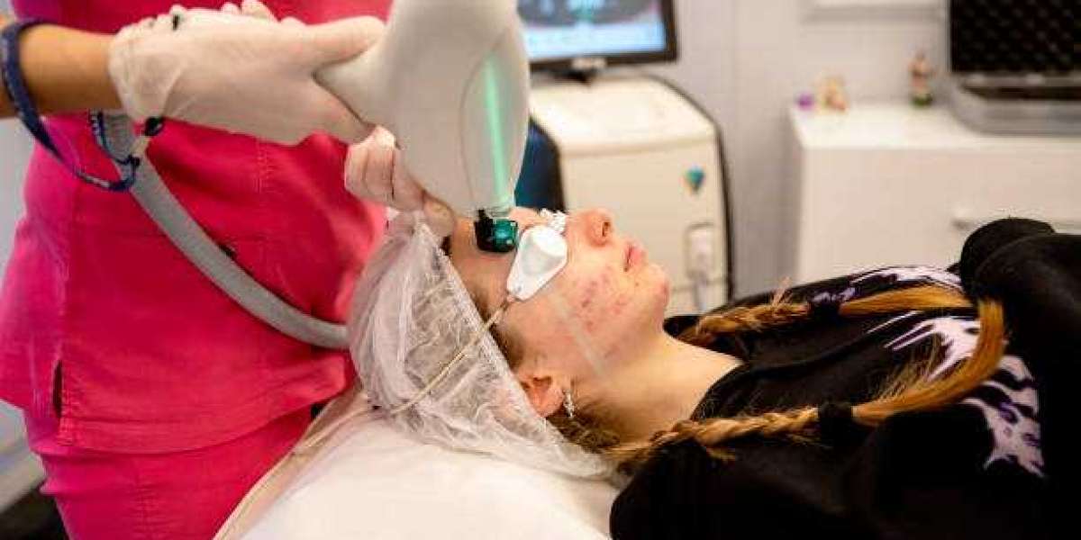 Q-Switch Laser and Its Impact on Treating Acne Scars in Riyadh