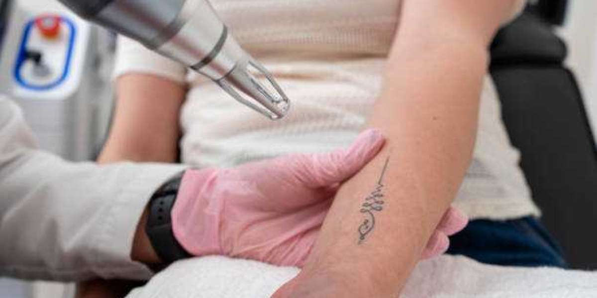 Laser Tattoo Removal for Fading Dark and Colorful Tattoo Inks