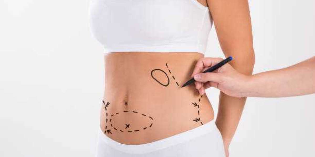 Your Essential Resource for Understanding Lipo Abdominoplasty in Riyadh