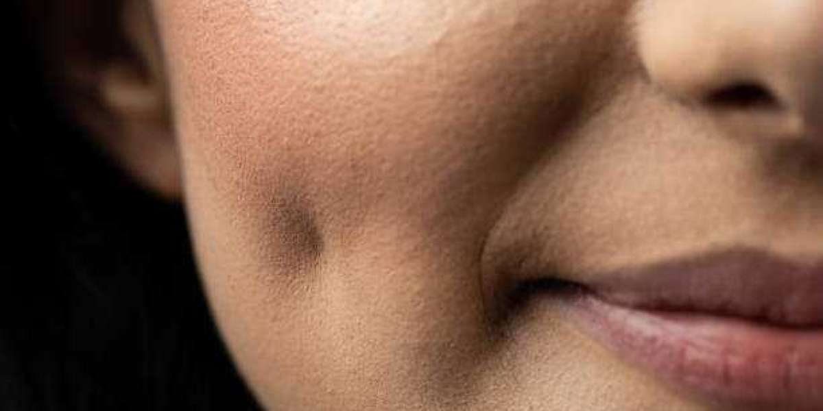 Dimple Creation Options to Improve Facial Symmetry and Charm