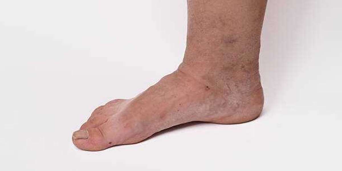 Why Many People Choose Varicose Veins Treatment for Relief