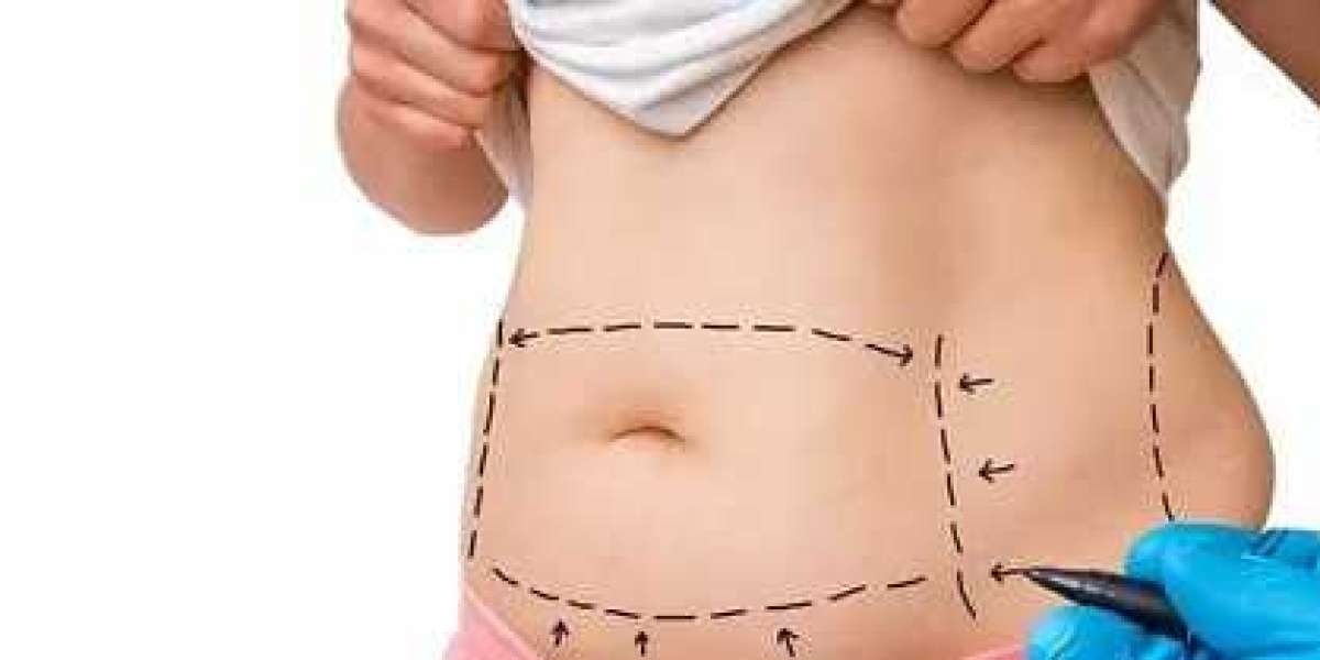 How Long Does It Take to Recover from Liposuction?