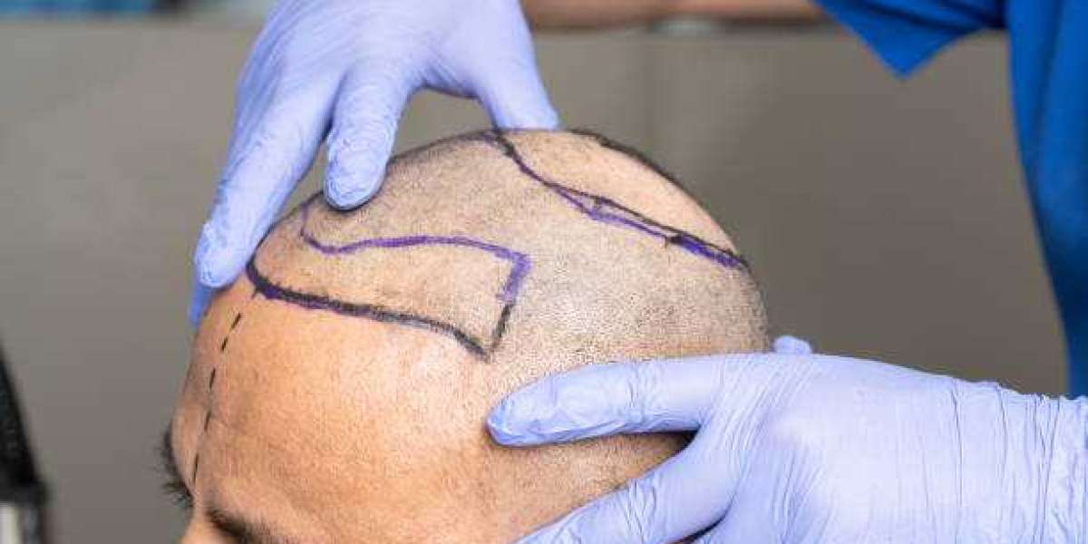 Innovations and Techniques in Hair Transplant in Riyadh