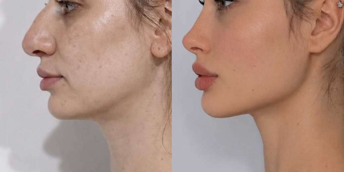 The Growing Demand for Customized Rhinoplasty in Islamabad Approaches