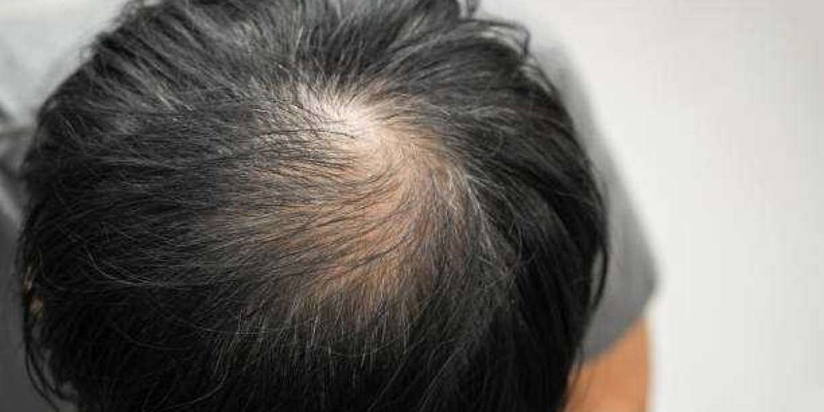 Exosomes Therapy for Hair Loss for Better Hair Volume Naturally