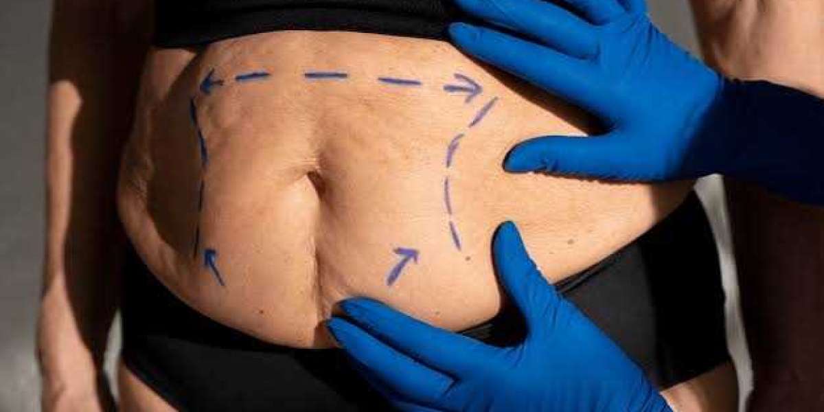 Types of Liposuction Procedures Available in Islamabad