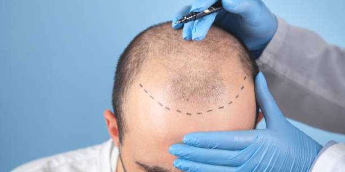 Benefits and Expectations of a 5000 Grafts Hair Restoration Treatment