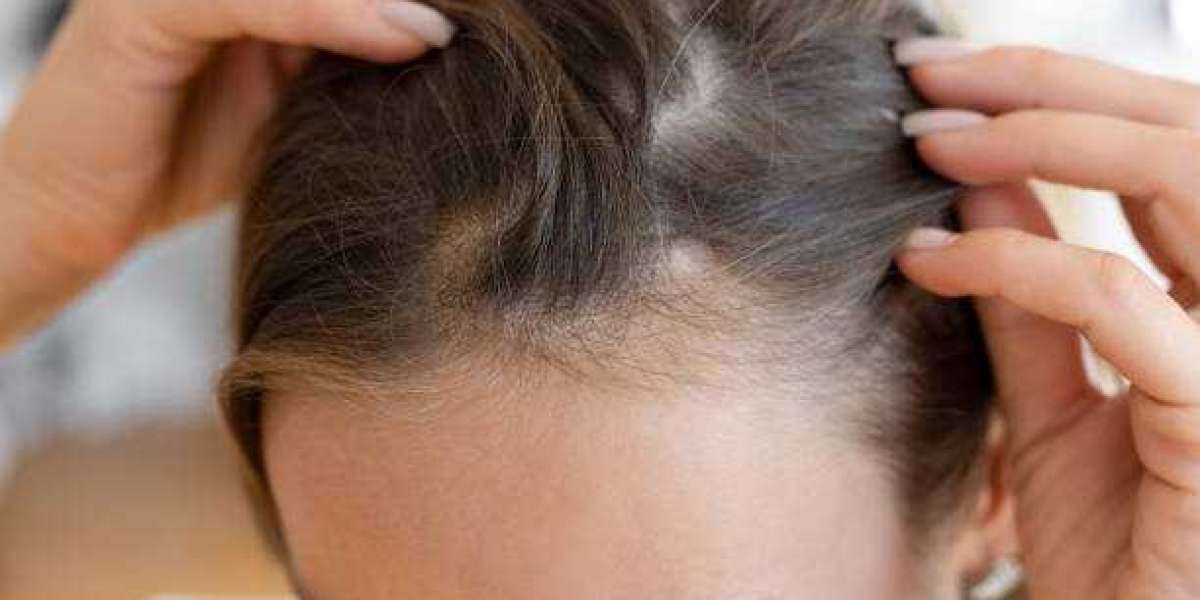 Safe and Effective Hair Loss Treatment in Riyadh