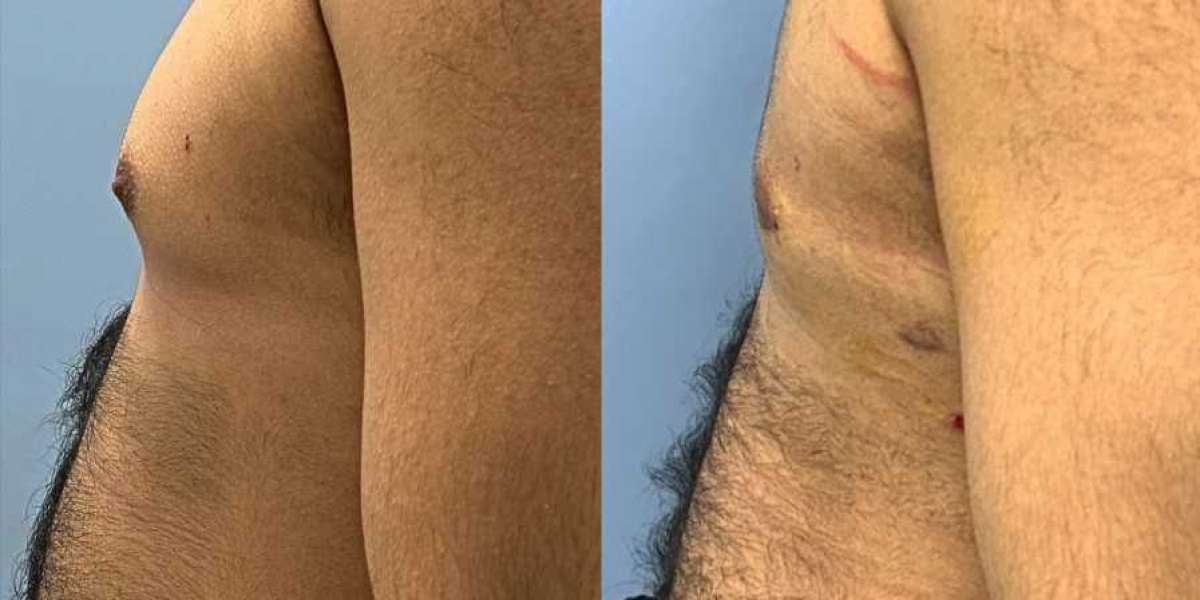 Before You Choose Best Liposuction in Islamabad: Important Things to Know
