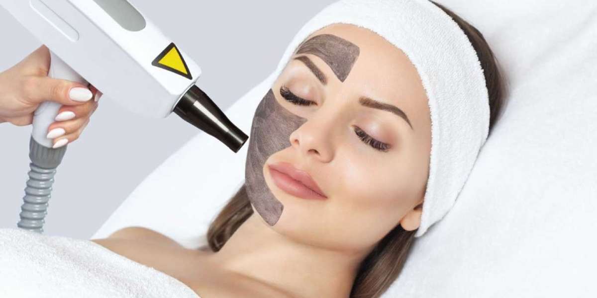 Laser Carbon Peel in Islamabad: How Many Sessions Might You Need?
