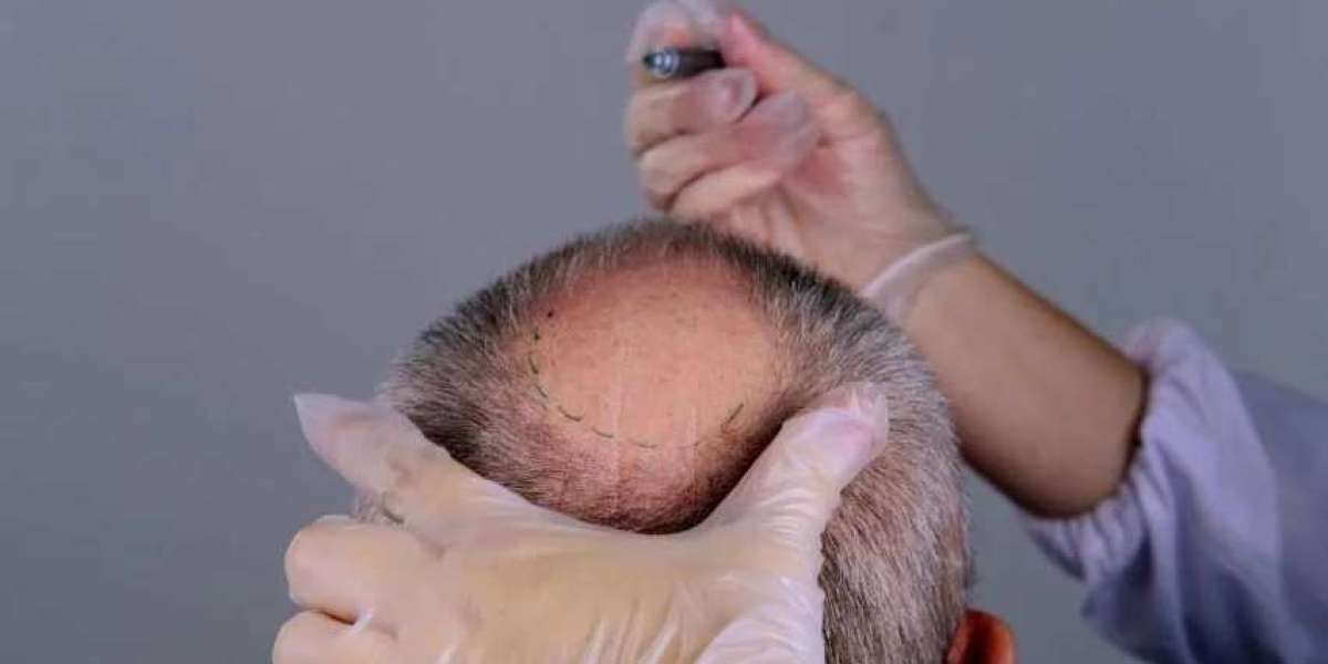 Finding Skilled Providers of DHI Direct Hair Implant in Dubai