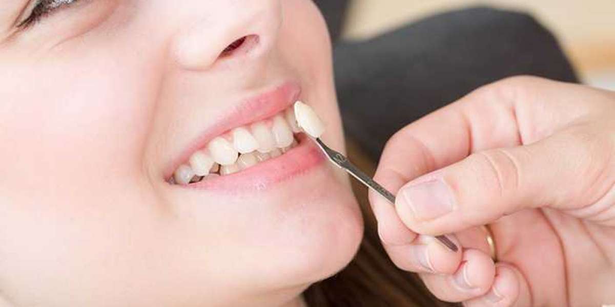 How Much Is Dental Veneers Cost in Pakistan? A Patient-Friendly Guide