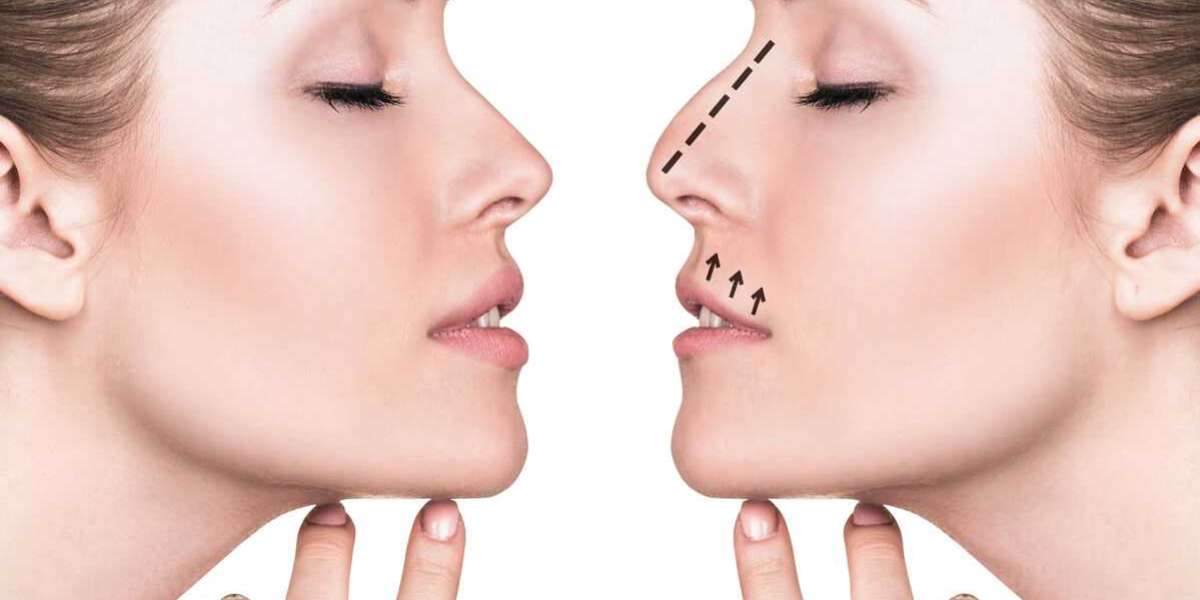 Creating Facial Harmony With Rhinoplasty in Islamabad: The Art Behind Natural Beauty