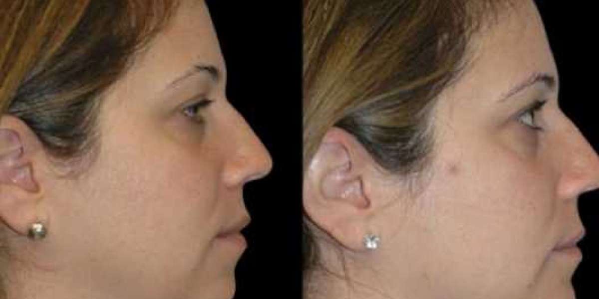 Double chin removal in Dubai Confidence Boost