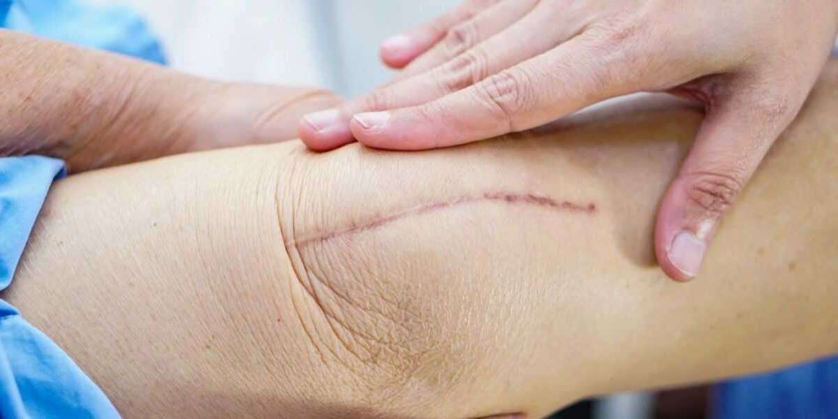Does Surgical Scar Revision Help Achieve Polished Skin Outcomes?