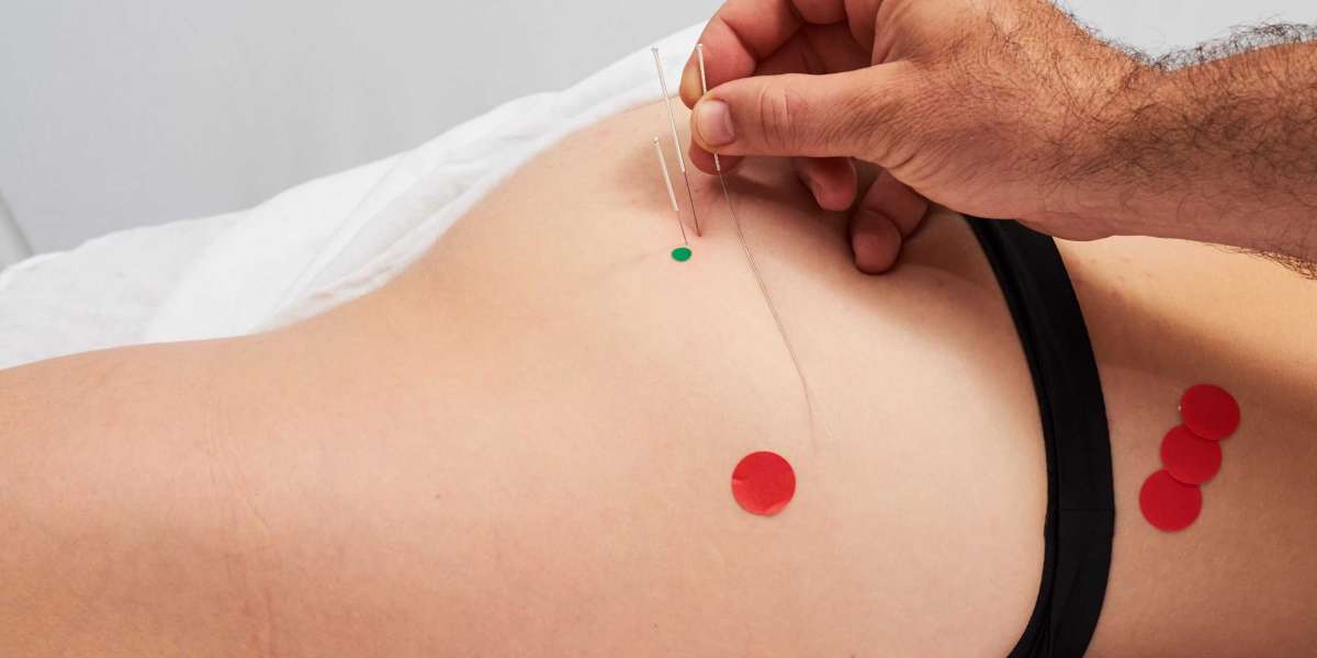 Acupuncture For Sciatica NYC