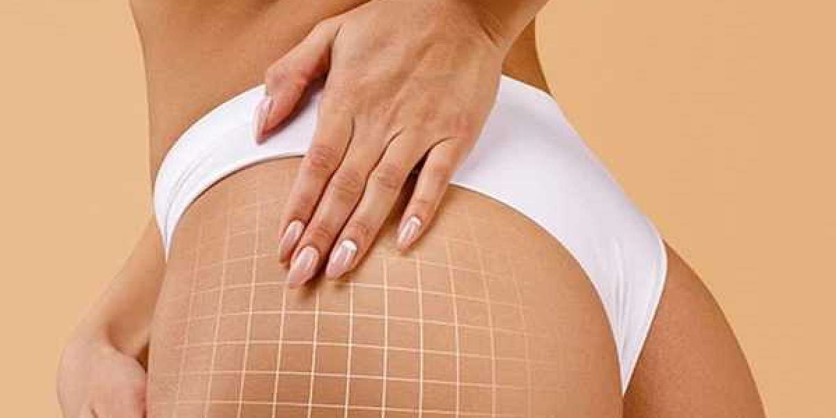 Butt Fillers In Dubai: Create Fuller Curves With Subtle Definition