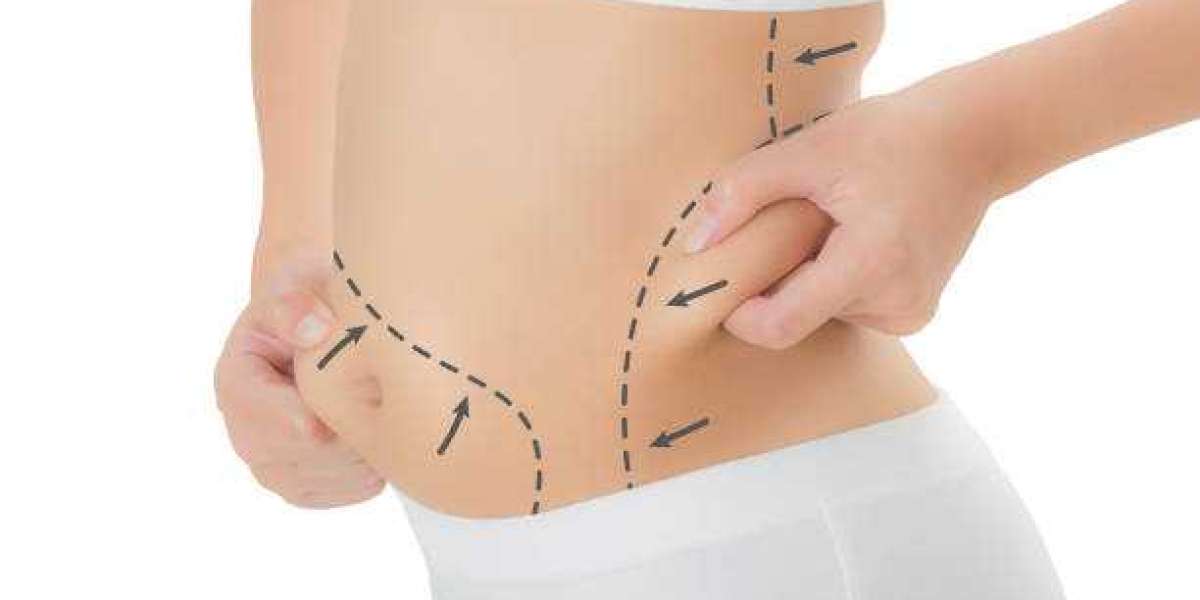 Fat Melting Injections for Improving the Look of Localized Fat