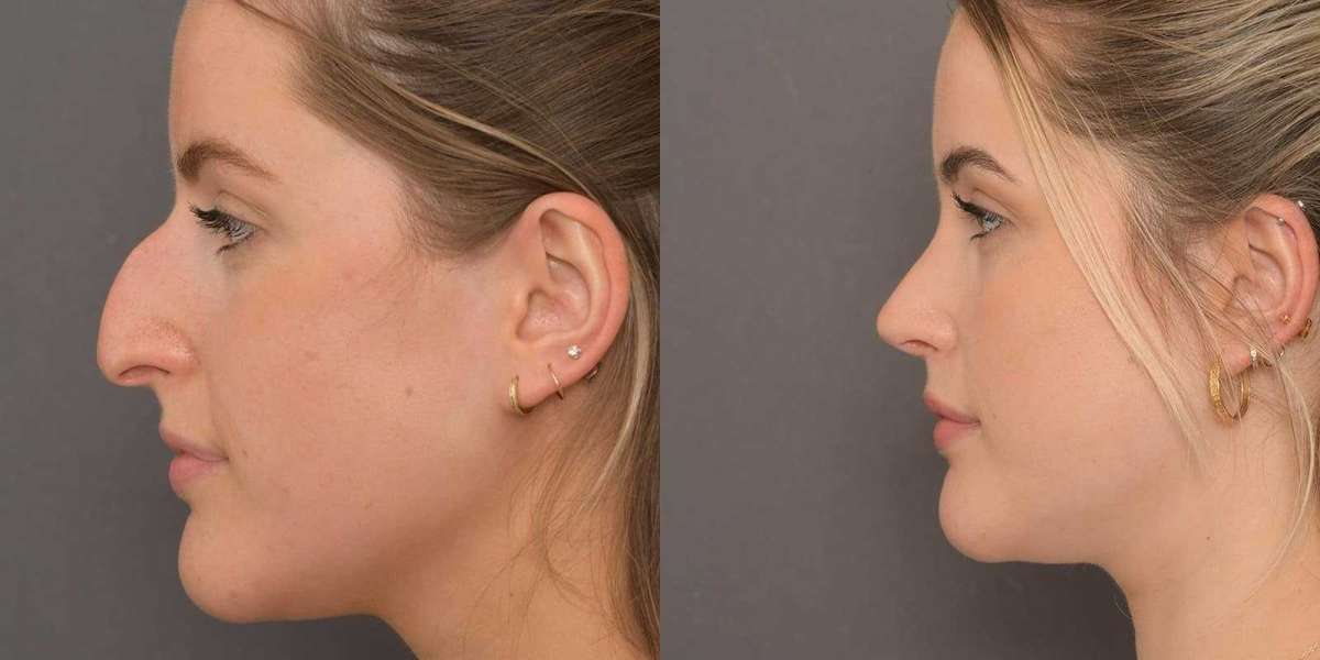 Rhinoplasty Cost in Islamabad: Understanding Surgeon, Hospital, and Anesthesia Charges