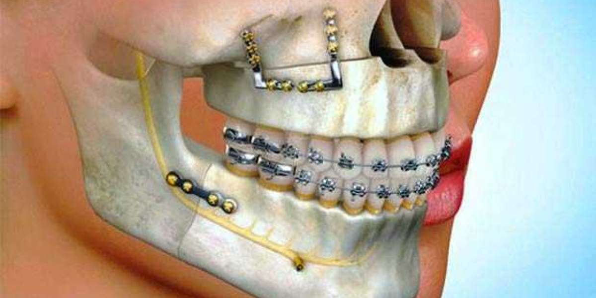Jaw Surgery in Islamabad: How to Identify a Reliable Clinic