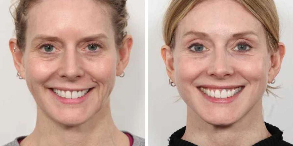 Thread Lift Treatment in Dubai for Youthful Facial Contours