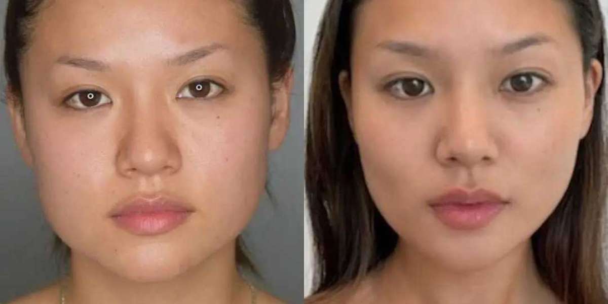 Why Choose Buccal fat removal in Dubai