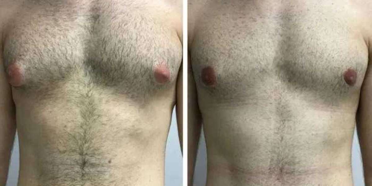 Best Gynecomastia Surgeons in dubai and Natural Chest Proportions