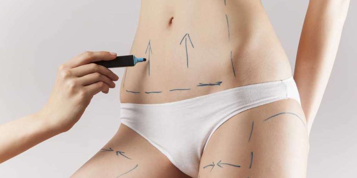 Liposuction In Islamabad: Red Flags to Watch for Before Choosing a Clinic