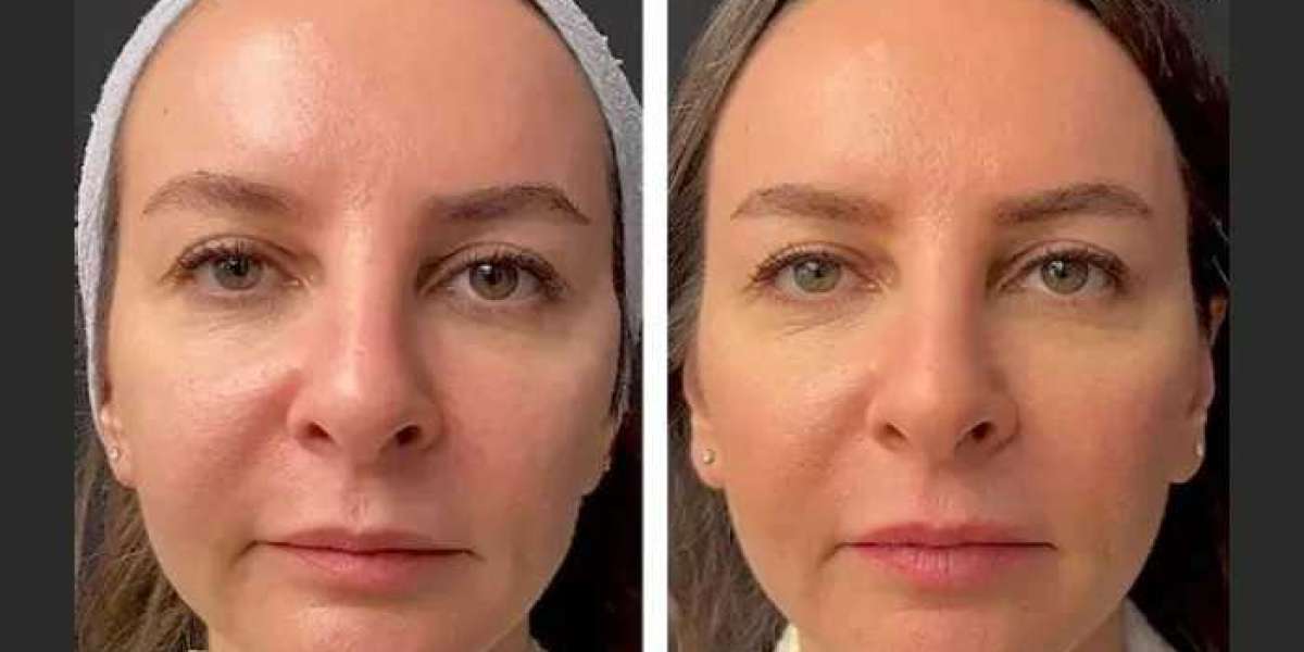Best Plastic Surgeon in Dubai for Mesotherapy: Skin Hydration & Radiance
