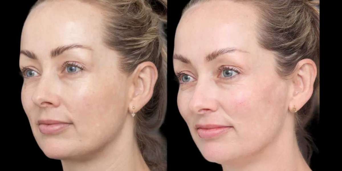 Why Cheek Fillers Are Popular in Best Aesthetic Clinics in Dubai