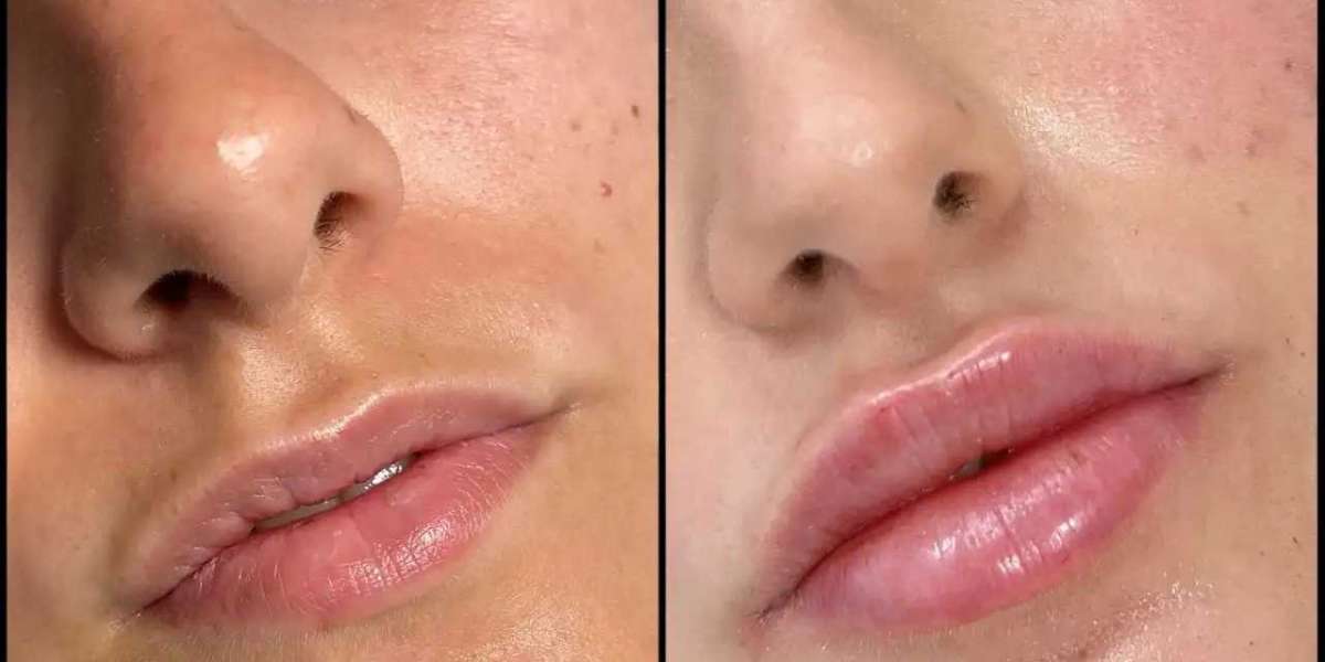 Best Aesthetic Clinics in dubai for Quality Dermal Fillers
